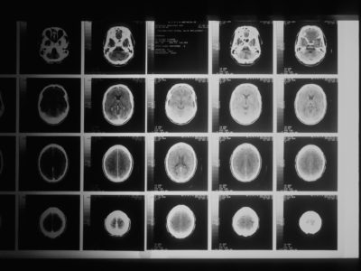 Alcohol's Damaging Effects on the Brain