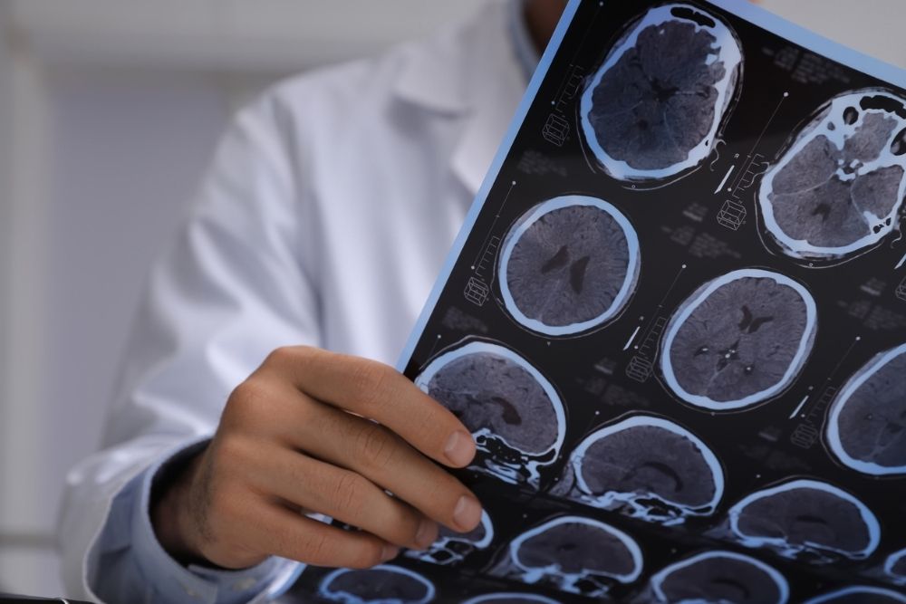 A doctor in a white coat holds and examines a sheet of brain CT or MRI scans, with several images of brain cross-sections visible.
